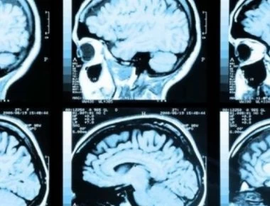 Ανεύρυσμα στο κεφάλι: Πώς θα αναγνωρίσετε τη ρήξη πριν να είναι πολύ αργά